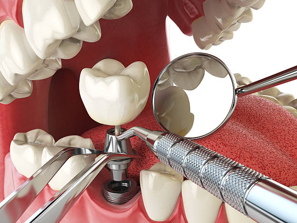 Best Emergency Dental Care for Broken or Chipped Teeth in Saybrook Manor, CT